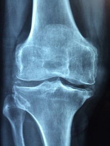 knee-1406964_1280